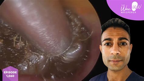 1060 Extremely Blocked Ear Wax Removal Olive Oil Talk