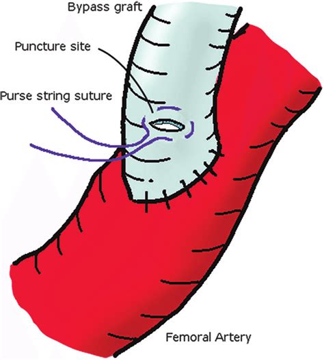 Aorto Femoral Bypass Graft Is Punctured After Placement Of A