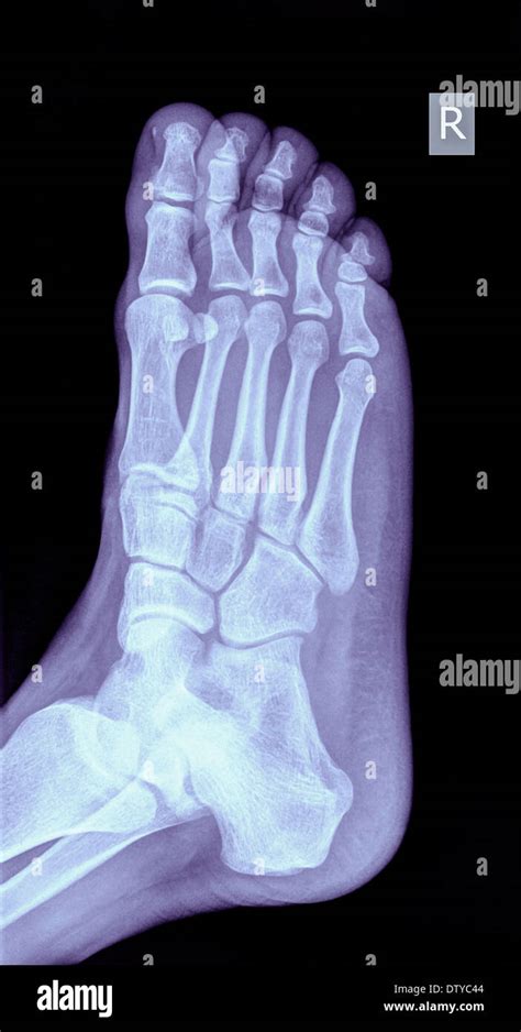 Radiographie D Un Pied Montrant Une Fracture Dans Le Me D Un