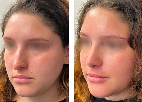 Female Rhinoplasty Best Rhinoplasty Los Angeles