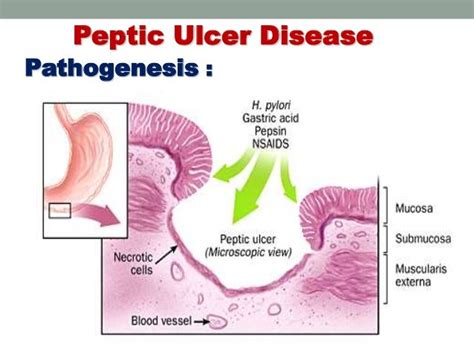 B1 Git Med1 Peptic Ulcer Disease