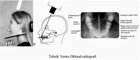 Teknik Radiografi Dental Dent Ias Notes