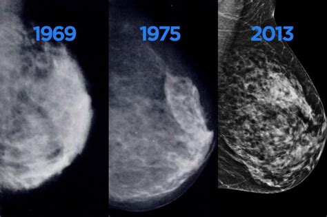 4 Essential Benefits Of Getting A Mammogram