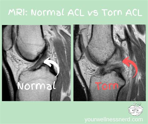 Comprehensive ACL Injury Guide: Why Mobilizing Your Ankles May Save ...