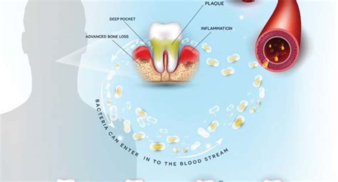 Gum Disease Connection To Heart Disease Florida Independent