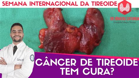 C Ncer Tireoide Tem Cura Semana Internacional Da Tireoide Youtube