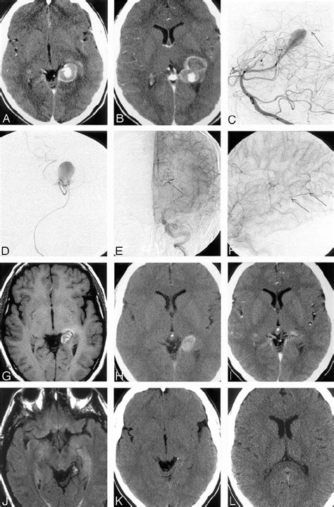 Partially Thrombosed Giant Aneurysm Of The P P Segment Of The Left