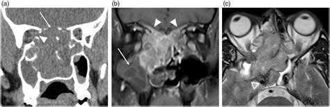 Imaging Review Of The Anterior Skull Base Olivia Francies Levan