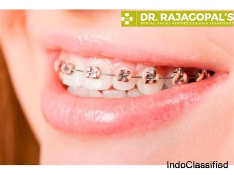 Braces A Medical Device To Align Cross And Overlapping Teeth.