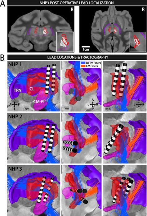 Central Thalamic Deep Brain Stimulation Ct Dbs Of Primary Ascending