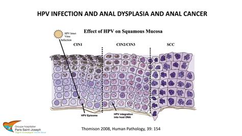 Biology Of Anal Squamous Cell Carcinoma Ppt