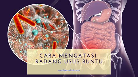 Cara Menyembuhkan Usus Buntu Tanpa Operasi Rintiksedu Id