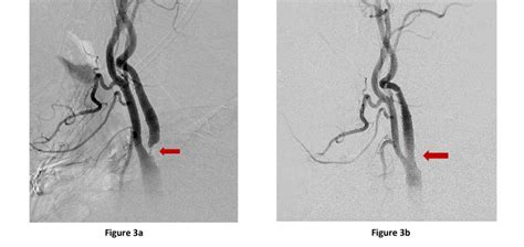 Carotid Stenosis | Baylor Medicine