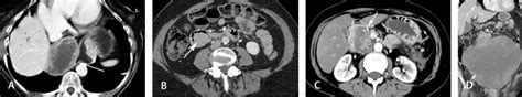 Gastrointestinal Stromal Tumors A Typical Appearances Of A Gastric Download Scientific