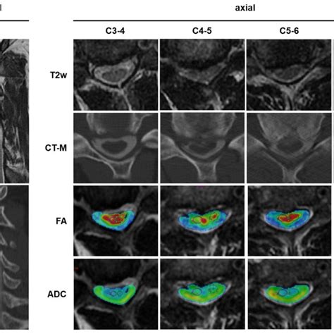 Preoperative Sagittal And Axial T2 Weighted Mri T2w And Ct M As Well