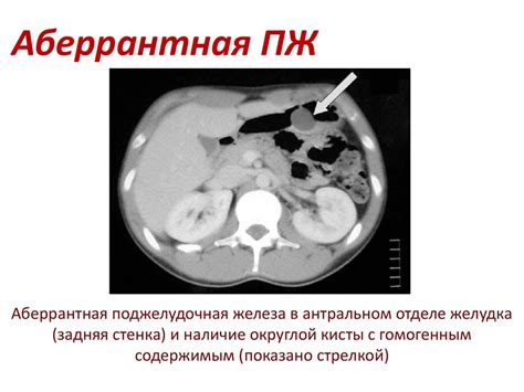 Поджелудочная железа. Аномалии развития (добавочная и кольцевидная ...