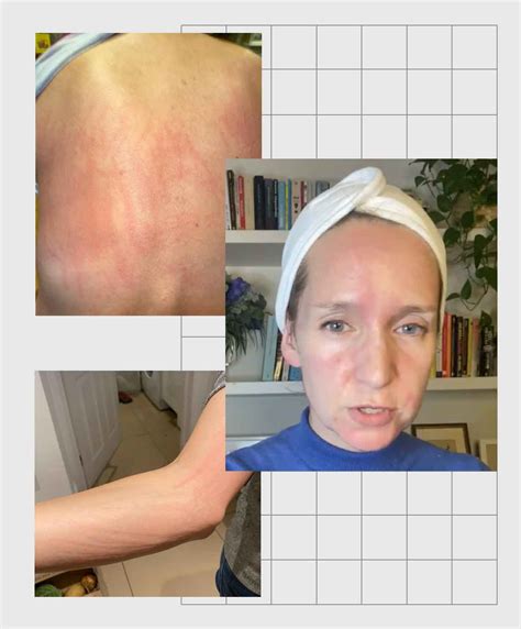 What Is Chronic Idiopathic Urticaria Hives Symptoms Causes