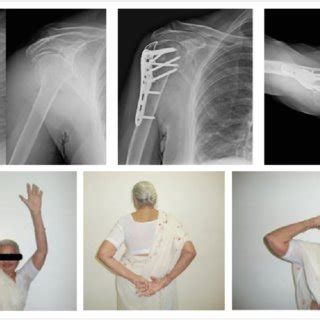 Open Reduction And Fixation Of Proximal Humerus Fracture Dislocation