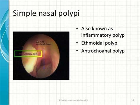 Nasal Polypi