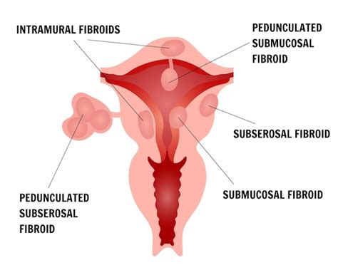 Premium Vector Infographic Or Females Fibroids In Vector Illustration