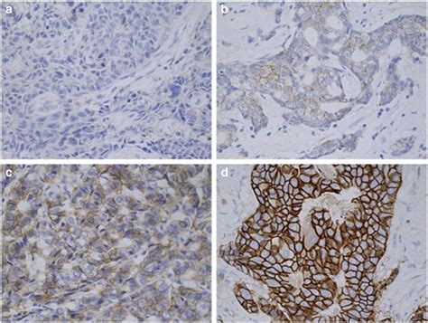 Her2 Human Epidermal Growth Factor Receptor 2 Expression Status