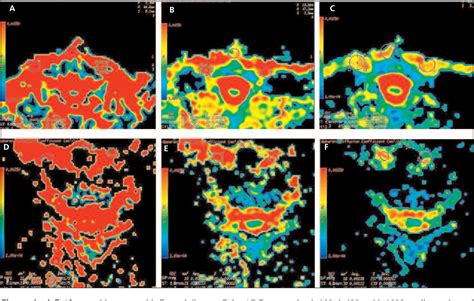 Figure 1 From The Role Of Diffusion Weighted Mr Imaging For Differentiation Between Graves