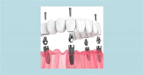 Implantes Dentales All On Four Ventajas De Esta Pr Tesis Fija