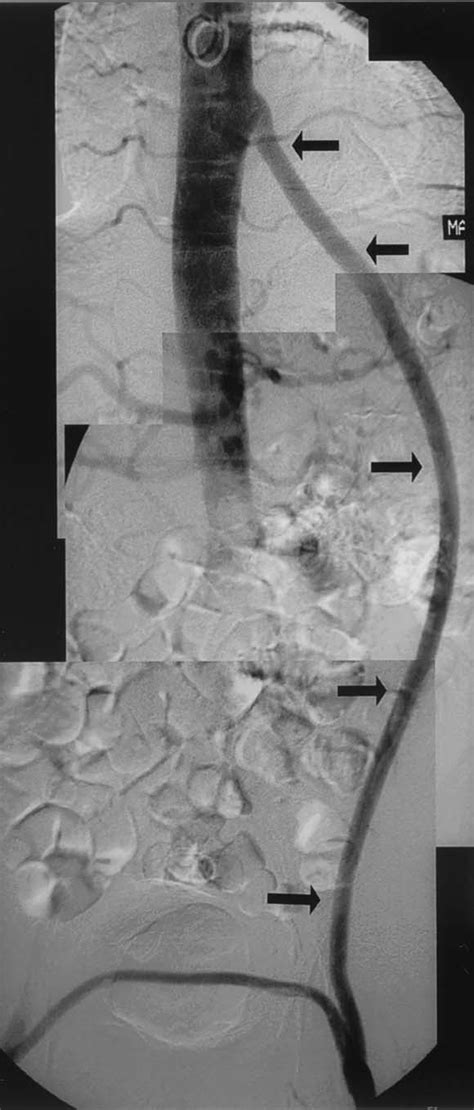 Totally Videoendoscopic Descending Thoracic Aorta To Femoral Artery Bypass Journal Of Vascular