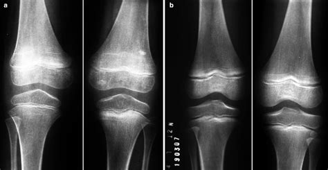 Juvenile Idiopathic Arthritis Xray