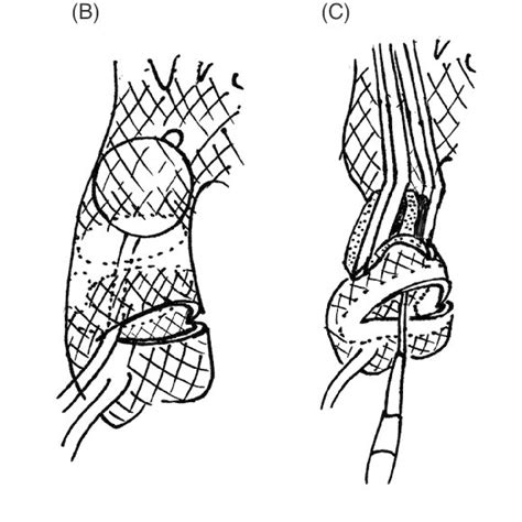 Pdf A Stepwise Aortic Clamp Procedure To Treat Porcelain Aorta