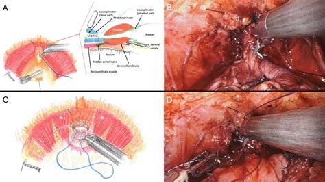 Robot Assisted Radical Prostatectomy Using The Novel Urethral Fixation