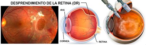 Retina Un Antes Y Un Despues