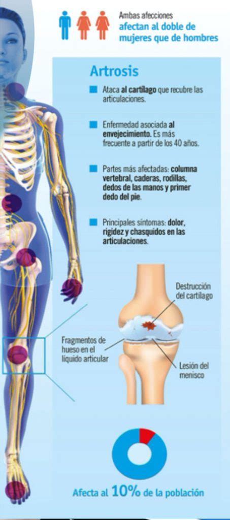 La Artrosis Ya Tiene Tratamiento Se Llama Mbst Vital Clinic