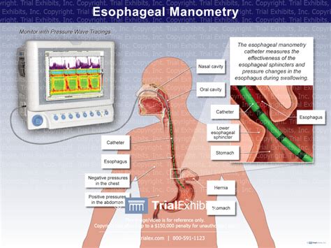 Esophageal Manometry Trialquest Inc