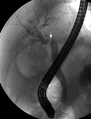 Figure 1 From Current Diagnosis And Treatment Of Benign Biliary