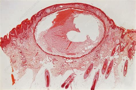 Apocrine Cystadenoma Lm Stock Image C0252672 Science Photo Library