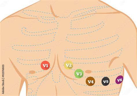 Chest ecg leads placement illustration. Six colored electrocardiography ...