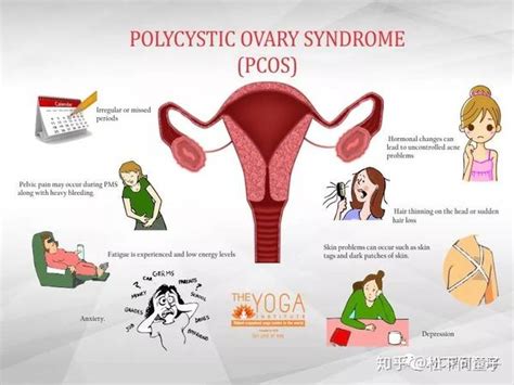 多囊卵巢和多囊卵巢综合征，是不是傻傻分不清楚？ 知乎