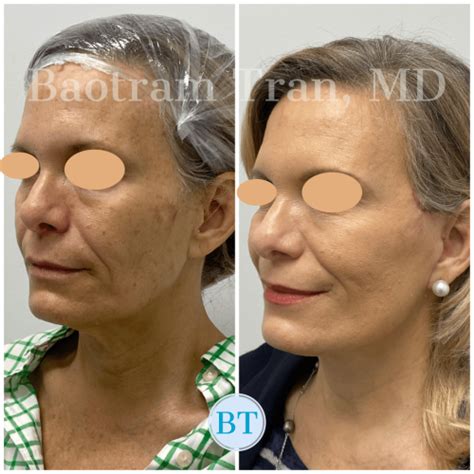 Mini Facelift Ft. Lauderdale - Facelift Surgeon - Dr. Tran