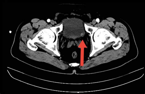 Ct Image Revealed A Nodule In The Left Wall Of The Bladder 0 8 Cm × Download Scientific