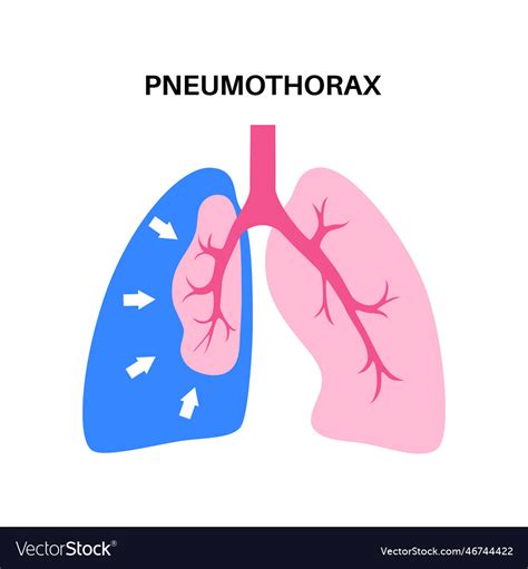 Pneumothorax Anatomical Poster Royalty Free Vector Image