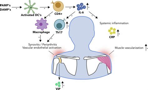 The Pathophysiology Of Polymyalgia Rheumatica Schematic Representation