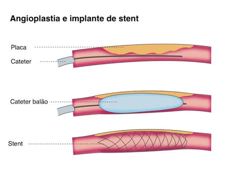 Angioplastia Coronaria Dr Freddy Loinaz