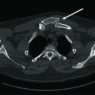 A Preoperative Computed Tomography Scan Of The Chest Axial Cut