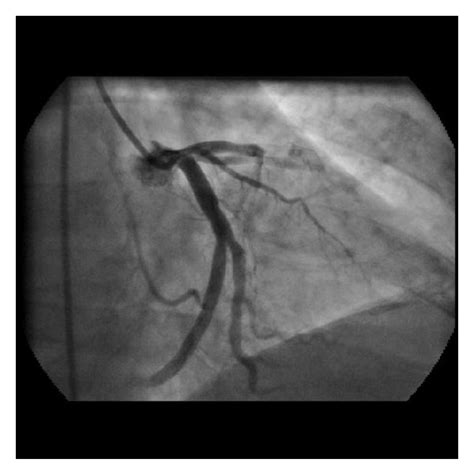 Total thrombotic occlusion of the previously stented segment of the ...