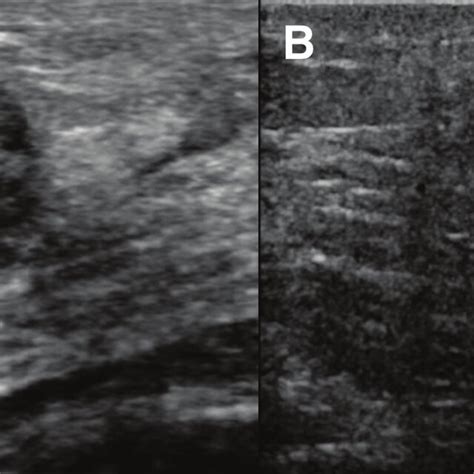 Radial A And Antiradial B Grey Scale And Color Doppler Ultrasound