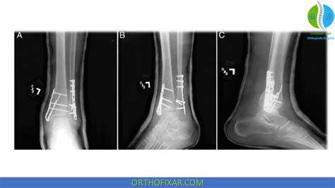 Treatment Of Medial Malleolus Fracture | OrthoFixar 2025