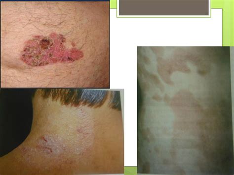 Dermatitis Atopica Y Eccema Numular Ppt