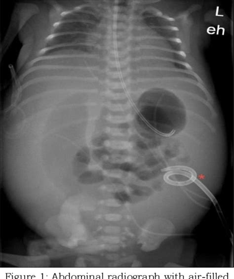 Figure From A Remarkable Case Of Intrauterine Intussusception Ileal