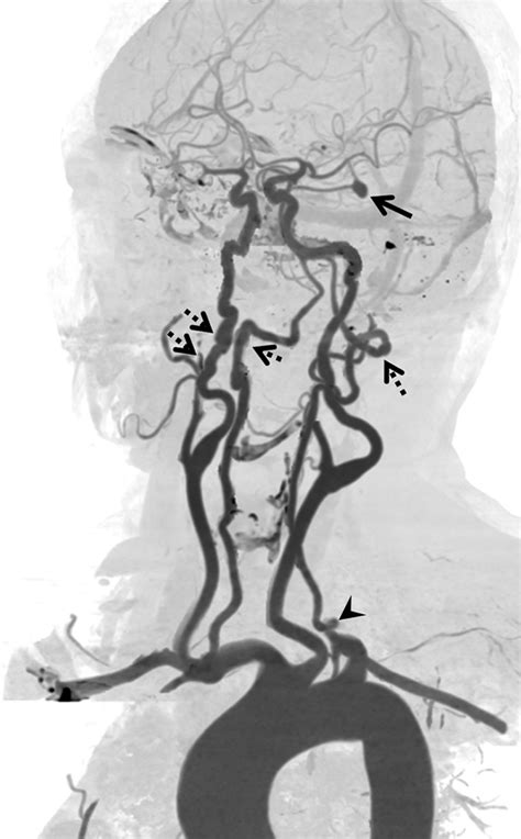 Fmd And Scad Sex Biased Arterial Diseases With Clinical And Genetic